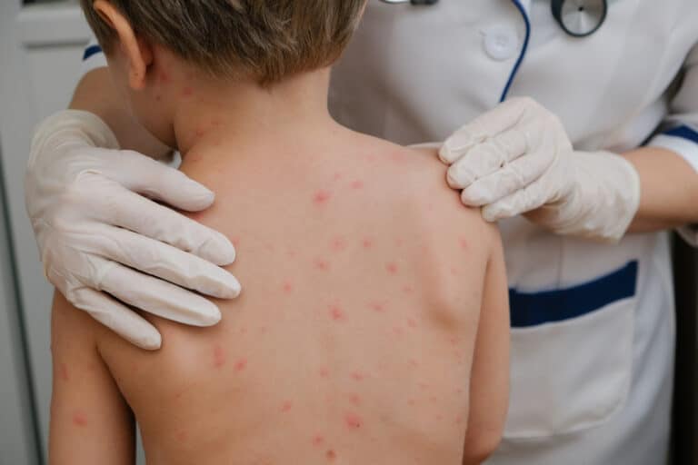 Varicella or Chickenpox | GIDEON